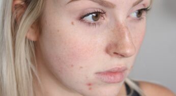 Top 10 Fastest Acne Treatment Ways for Teens