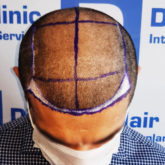 10 Best Hair Transplant Clinics In Turkey In 2022