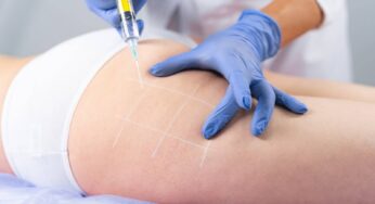 4 Most Common Methods to Reduce Your Cellulite