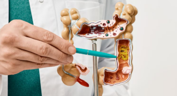 Colon Cancer Types and Treatment Options